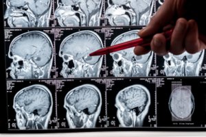 Nustebo net mokslininkai: paaiškėjo, kas vyksta žmogaus smegenyse susirgus Alzheimerio liga