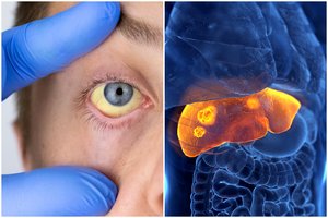 Kepenų vėžys – ypač klastingas: įsidėmėkite pirmuosius ligos ženklus