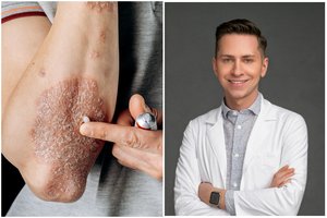 Žaloja odą ir pažeidžia sąnarius: nepagydoma liga serga beveik 100 tūkst. lietuvių