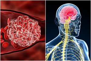 Gydytojas išvardijo insulto požymius: juos įsiminti nesunku, o laiku atpažinti – gyvybiškai svarbu