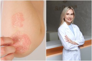 Gydytoja apie žvynelinę: nors liga neužkrečiama, ja sergantys vis dar stigmatizuojami