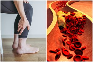 Kojos išduoda klastingą ligą: neįprasti požymiai, kad cholesterolio kiekis kraujyje viršija normą