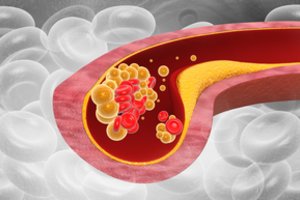 Norite išvengti bėdų dėl cholesterolio? Išbraukite šį maistą iš savo valgiaraščio