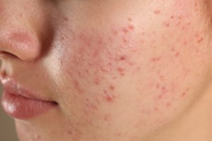 Aknė – veido odos liga, kurią gydant lengva suklysti: kaip teisingai ja pasirūpinti?