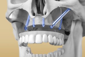 Ilgieji implantai – išsigelbėjimas praradus daugumą dantų?