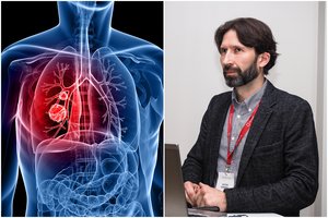 Gydytojas S. Zaremba ragina nenumoti į šio įpročio žalą: jis veda prie vėžio