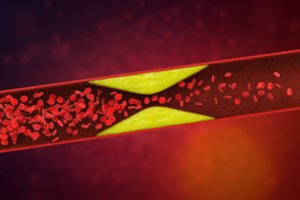 Chirurgas pasakė, kas stabdo kraujagyslių „kalkėjimą“: pagerins savijautą ir gyvenimo trukmę