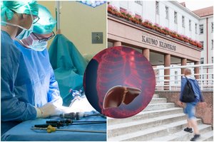 Kaune – mįslingas pacientas: neįprasta liga užsikrėtusio Petro kepenis ėdė kirmėlės