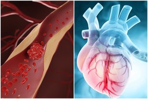 2024 m. sveikatos atradimai: netikėtas kraujo krešulių sukėlėjas ir širdžiai žalingas vitaminas