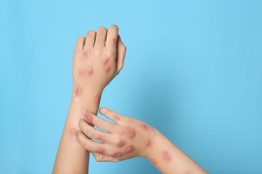 Prancūzijoje patvirtintas pirmasis naujos B raupų viruso atmainos atvejis
