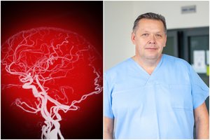 Naujovė smegenų aneurizmos gydyme: pirmą kartą tokią operaciją atliko Šiaulių ligoninėje