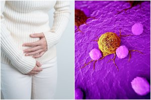 Klastingą vėžį moterims išduoda 3 simptomai: juos pajutus – nevalia delsti