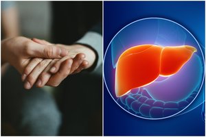 3 neįprasti požymiai, kad streikuoja kepenys: apžiūrėkite savo rankas