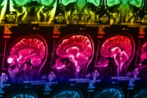 Epilepsija – ne tik traukuliai: gydytojas įvardijo mažiau atpažįstamą ligos signalą