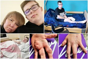 Kūną deformuojančia liga sergančio 17-mečio būklė blogėja: gydytojai nuleido rankas, šeima meldžia padėti