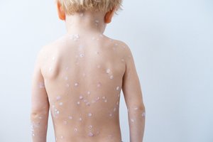 Vėjaraupiai – ne tik vaikų liga: kaip apsisaugoti ir gydytis susirgus?