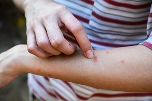 Kaip elgtis, susidūrus su niežais? Vaikų gydymas skiriasi nuo suaugusiųjų
