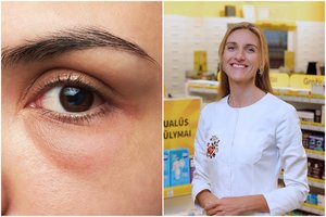 Tamsūs ratilai aplink akis – šių dienų problema: vaistininkė dalijasi būdais tam išspręsti