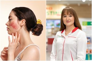 Rožinė – odos liga, kurią iššaukia žiemiški orai: kaip ją gydyti?