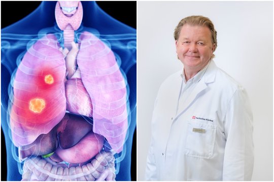 Gydytojas įspėjo, kas sukelia vėžį: tikimybė susirgti išauga kelis šimtus kartų