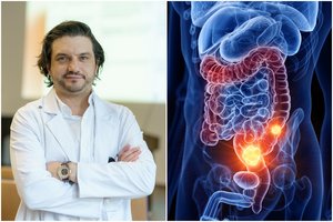 Gydytojas A. Dulskas pasakė, kam gresia storosios žarnos vėžys: nesunkų testą atlikti namie gali visi