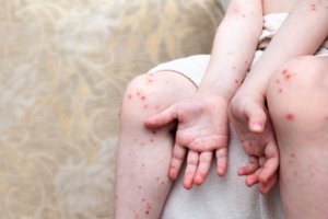 Teksase per tymų protrūkį mirė vaikas