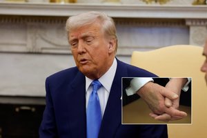 Ant D. Trumpo rankos – didžiulė mėlynė: Baltųjų rūmų paaiškinimas gali ir nustebinti