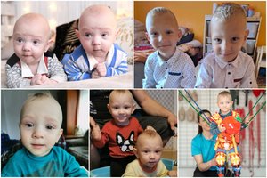 Vieno iš vilniečių dvynukų neaplenkė negandos: buvo blogai, bet po operacijos 5-mečiui tapo dar blogiau