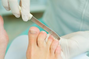 Įauginėjantys kojų nagai: vaistininkė atsakė, ką darote ne taip