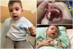 Privačiame Klaipėdos darželyje 2-ejų berniukas patyrė traumą, kuri išgąsdino net medikus: dantys sustumti į vidų, pasekmės – baisios