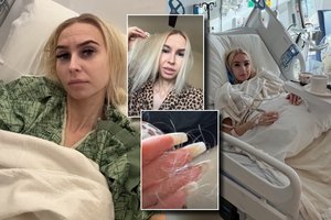 Su vėžiu kovojanti S. Milinytė su ašaromis akyse prabilo apie dar vieną sunkų etapą: parodė padarinius