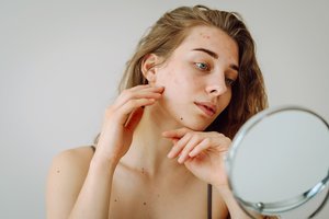 Gydytoja apie aknę: klaidinga manyti, kad jaunatviniai spuogai išnyks savaime