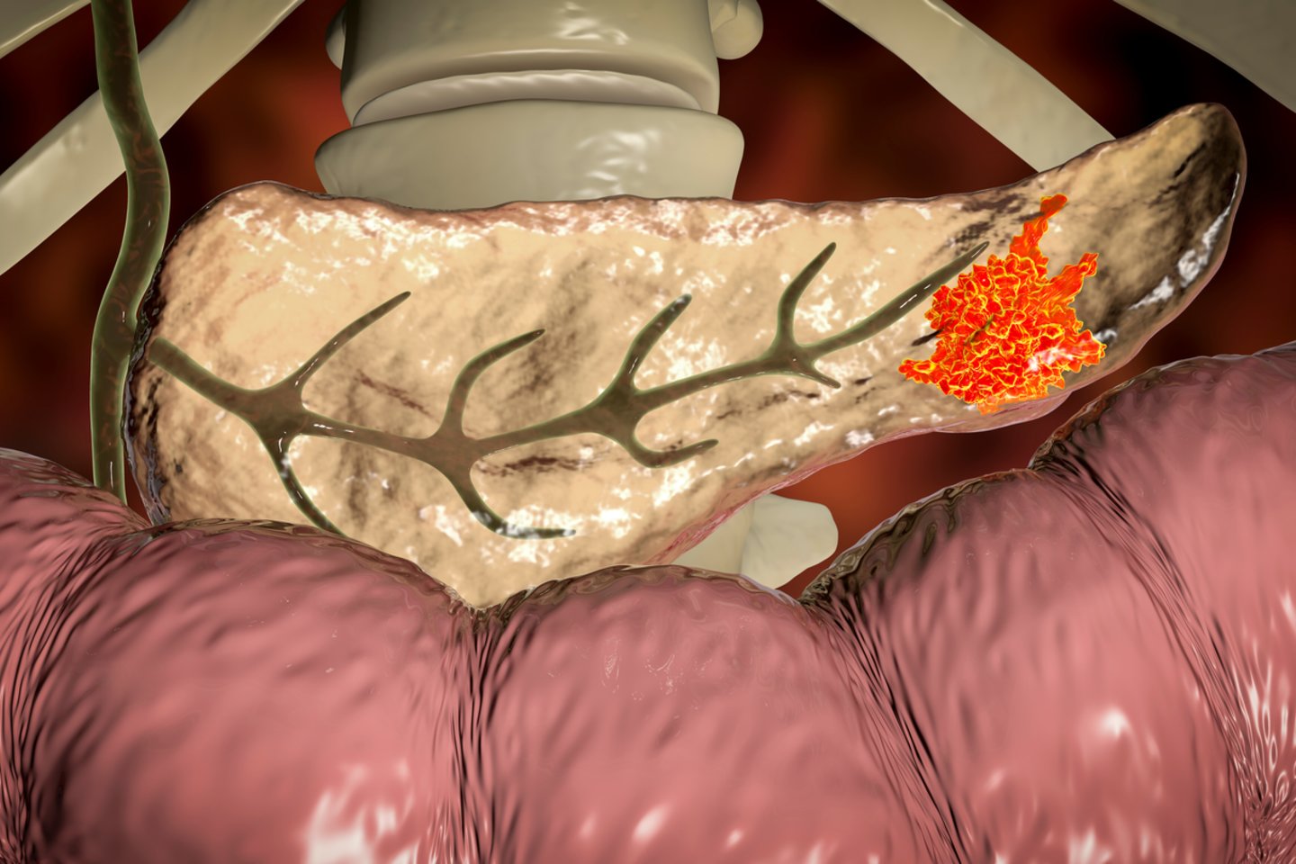 Kasos vėžys<br>Asociatyvinė 123rf iliustr.