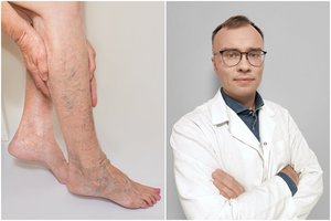 Melsvi kapiliarų „voratinkliai“ ant kojų: gydytojas pasakė, ką jie reiškia