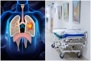 Apžvelgė mirtingumą nuo vėžio Lietuvoje: dėl vienos ligos – kraupūs skaičiai