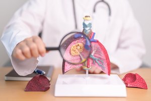 Klastingo vėžio simptomai: kas juos pražiopso, tam šaukštai būna po pietų