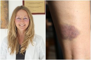 Ypač greitai atsiranda mėlynės? Gydytoja įspėja – tai gali rodyti pavojingą ligą