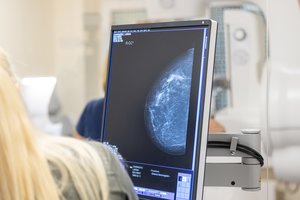 Gydytoja mamologė: tikrintis nuo krūtų vėžio svarbu pradėti jau nuo 20-ies