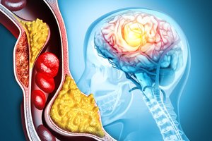 Šiurpus atradimas: ši medžiaga gali užkimšti žmogaus kraujagysles