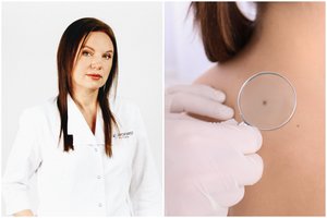 Gydytoja įvardijo, kaip atpažinti piktybinį apgamą: pasitikrinkite jau dabar