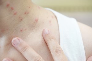 Šeimos gydytoja: vėjaraupiai gali sukelti sunkias komplikacijas, kurių būtų galima išvengti pasiskiepijus