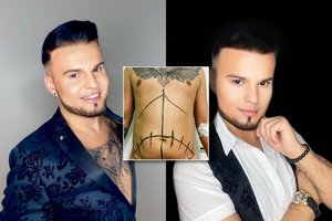 Vytenis Partikas parodė pokyčius po riebalų nusiurbimo operacijos: „Skonis draugų neturi“