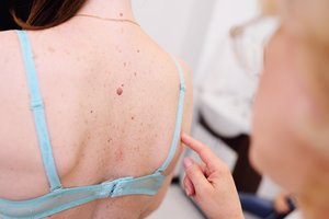 Ant kurios kūno vietos labiausiai linkęs pasireikšti odos vėžys? Čia atsiranda pavojingi apgamai