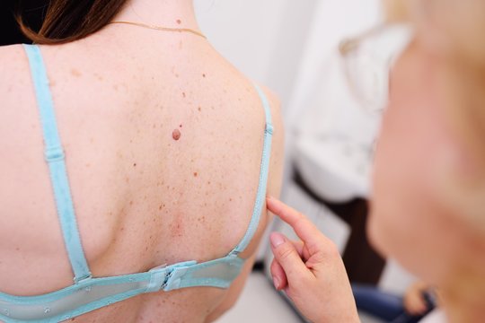 Ant kurios kūno vietos labiausiai linkęs pasireikšti odos vėžys? Čia atsiranda pavojingi apgamai