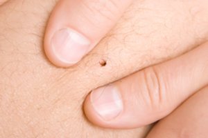 Kaip teisingai ištraukti įsisiurbusią erkę: nedarykite šios klaidos