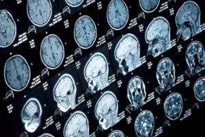 Išsėtinė sklerozė klaipėdietei išryškėjo vos 19-ikos: „Savo pavyzdžiu noriu paneigti mitą“