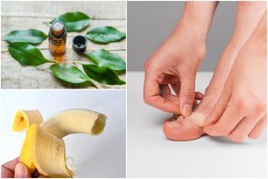 Įsidėmėkite: liaudiškos priemonės, kurios veiksmingai padeda panaikinti karpas