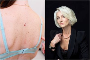 „Aš tik trumpam“: klaida, dėl kurios gresia klastinga odos liga