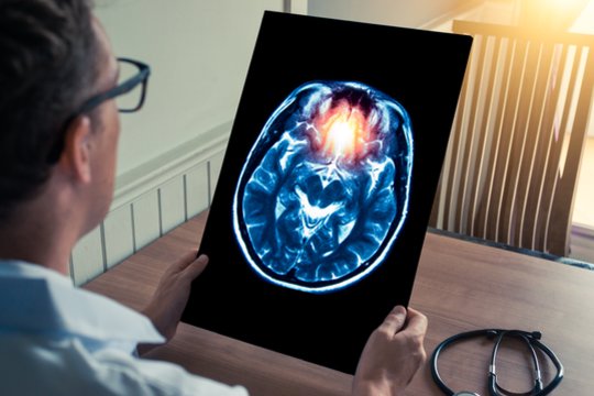 Pirmoji pagalba ištikus epilepsijos priepuoliui: įsidėmėkite šias taisykles