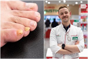 Kojų nagų grybelis: vaistininkas pasakė, kiek trunka jo nusikratyti